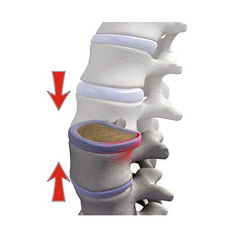 L hernie discale notre solution Clinique Solution Santé Chiropratique Inc